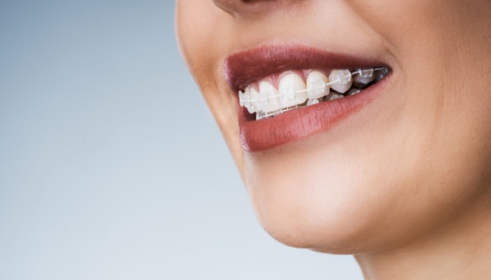 diferencia entre ortodoncia invisible y brackets